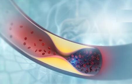 Coronary Heart Disease