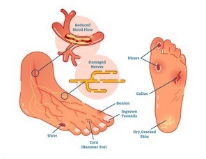 Diabetic Foot Ulcers