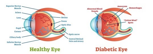 Diabetic Retinopathy