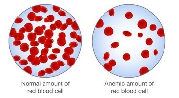 Anemia