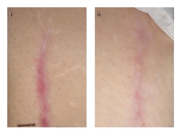 Photographic images showing the improvements in scarring following scar revision surgery with avotermin versus placebo at Month 7 (i) and Month 12 (ii).