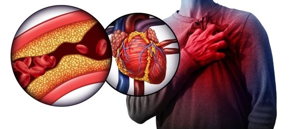 Coronary Artery Disease